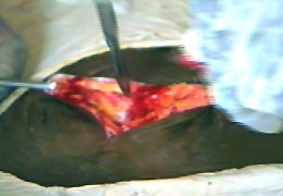 OPERACION DE APENDICITIS